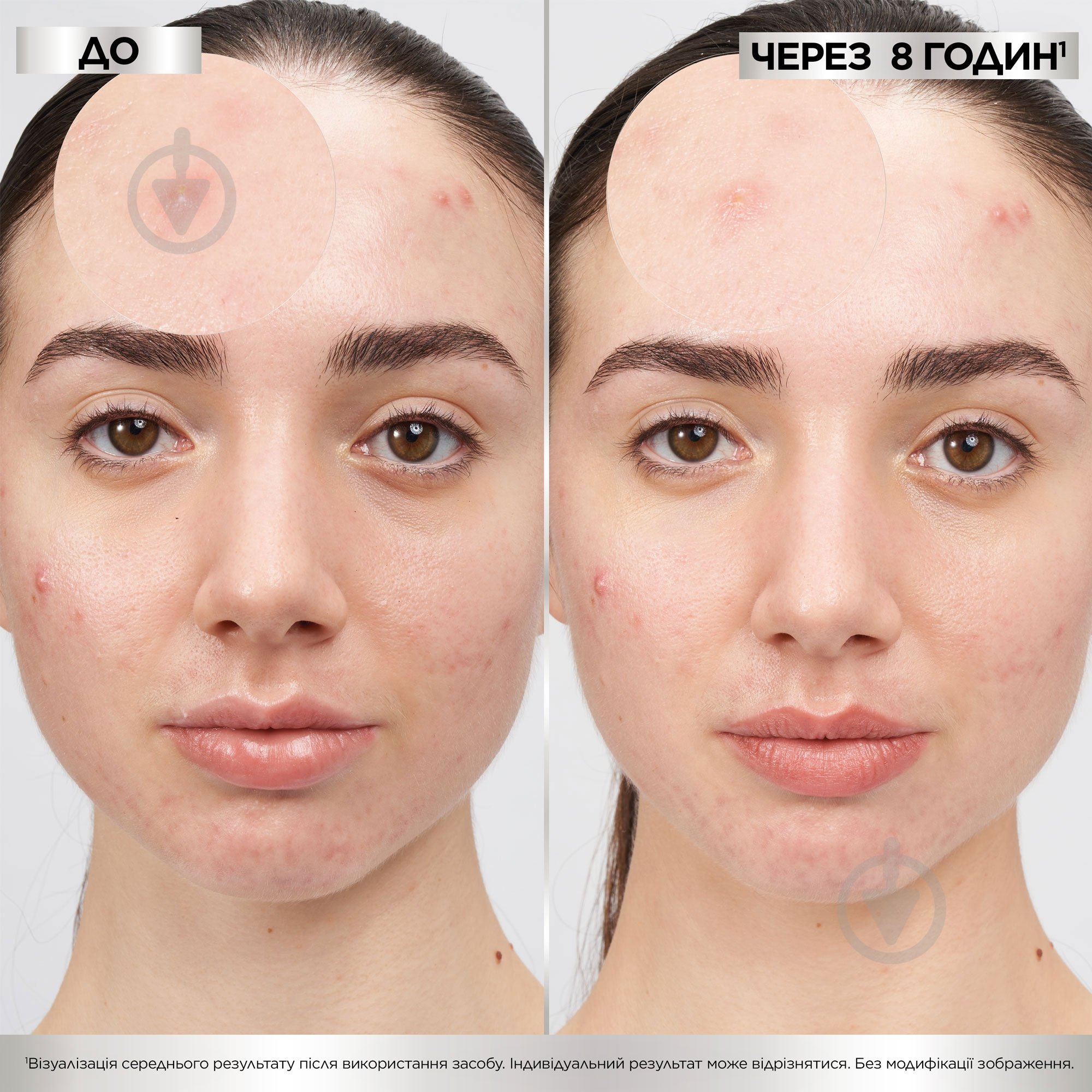 Патчи Garnier против прыщей гидроколлоидные Pure active 22 шт. - фото 4