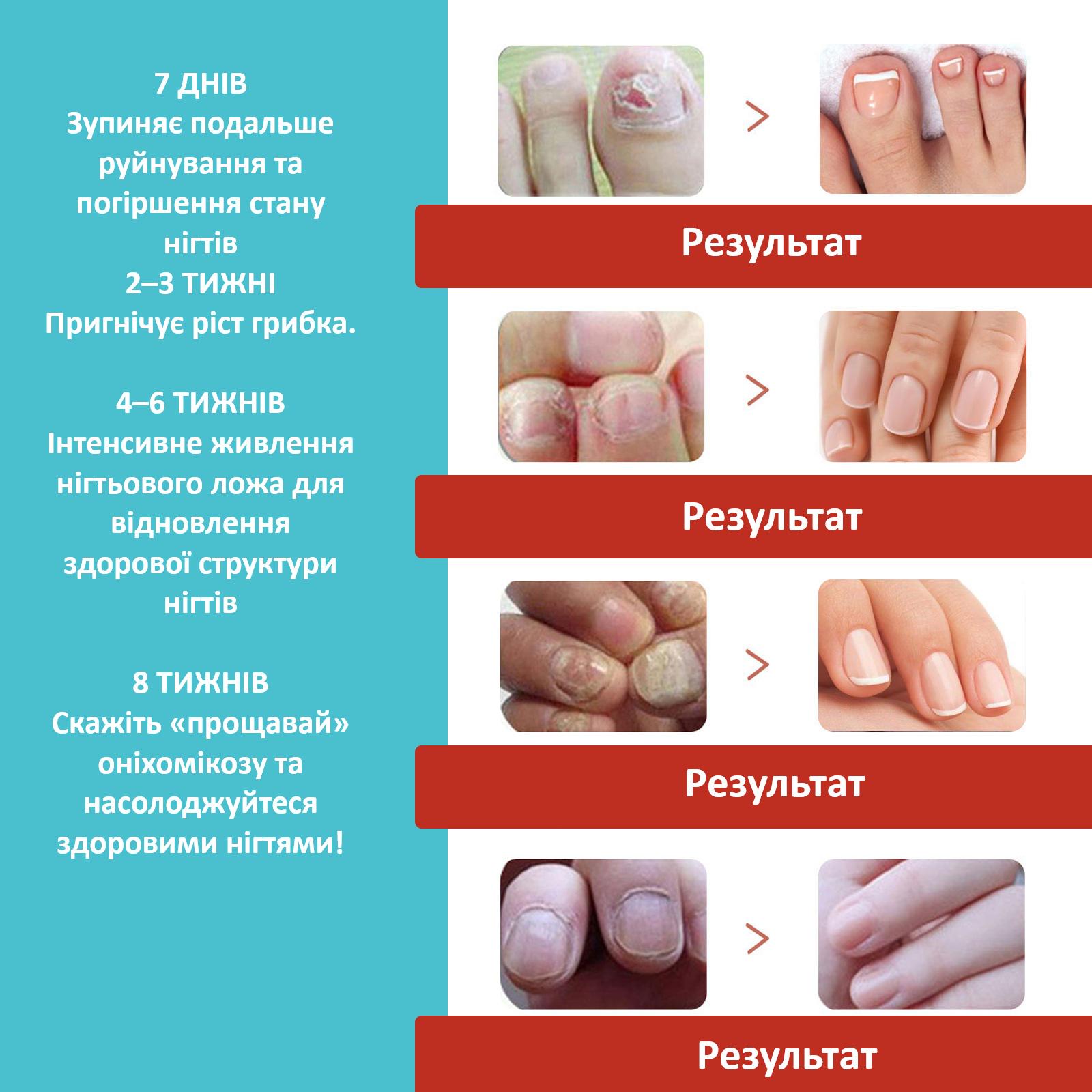 Коригувальні пластир-наклейки R9360 для врослих нігтів Nail Patches в упаковці 16 шт. - фото 5 Коригувальні пластир-наклейки R9360 для врослих нігтів Nail Patches в упаковці 16 шт. - фото 5