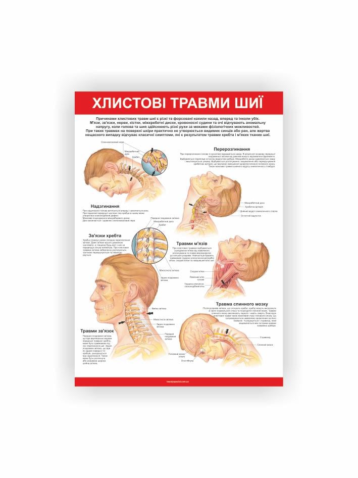 Плакат Vivay Хлыстовые травмы шеи 30х40 см (25698400)