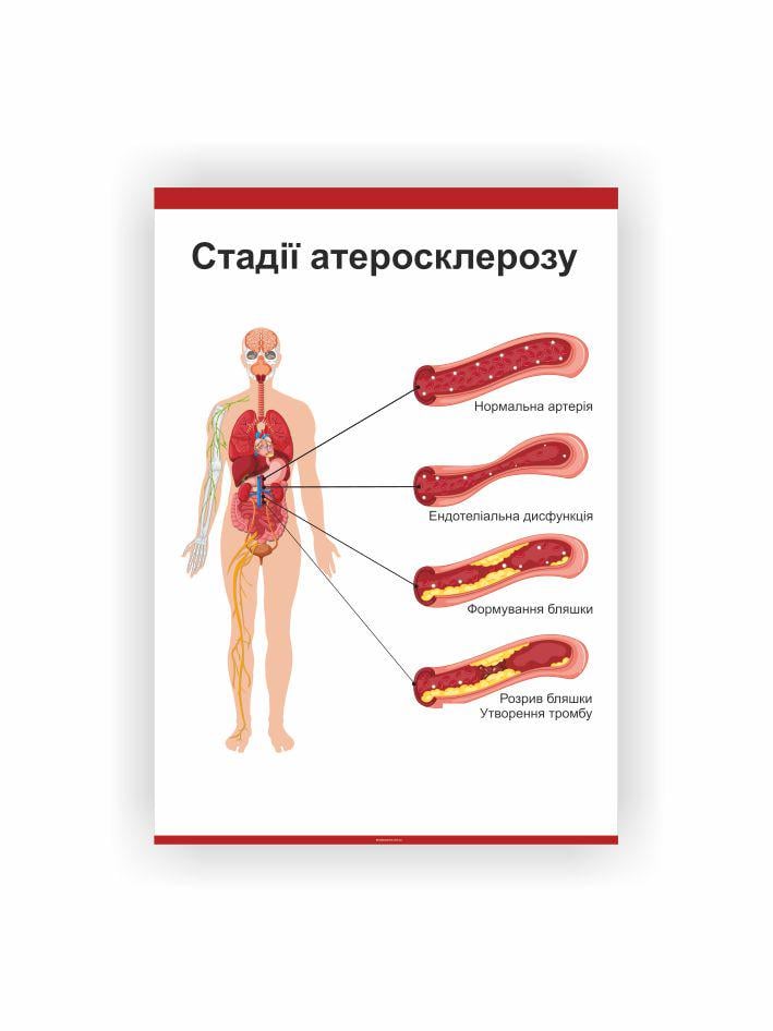 Плакат Vivay "Стадии атеросклероза" 60х80 см (25807534)