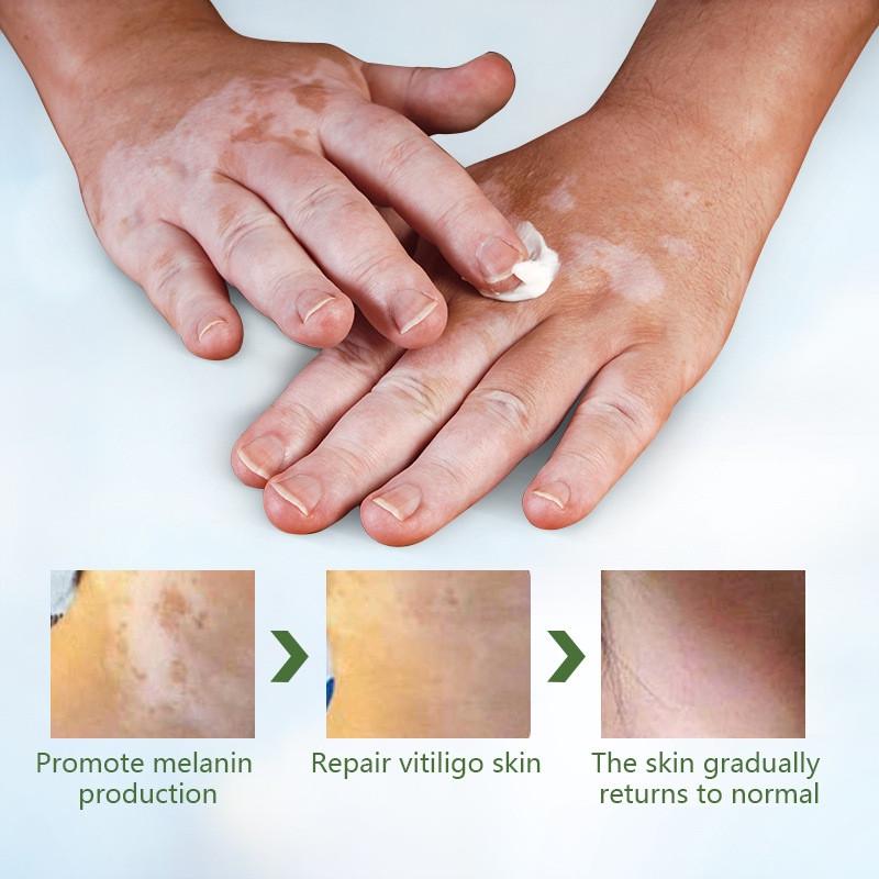 Мазь для витилиго Sumifun Vitiligo 20 г - фото 2 Мазь для витилиго Sumifun Vitiligo 20 г - фото 2