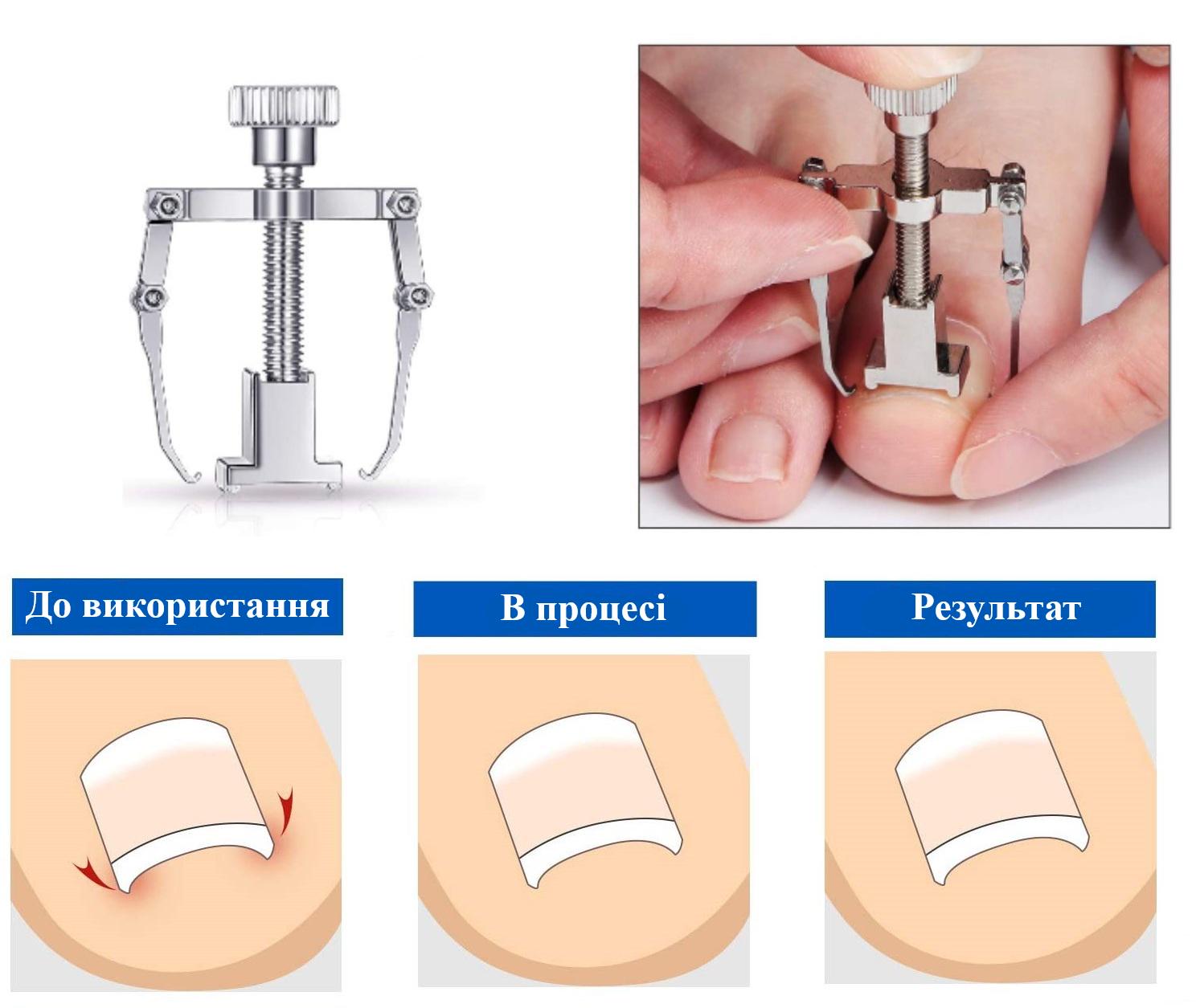 Коректор з металу для лікування врослого нігтя (R9480) - фото 11