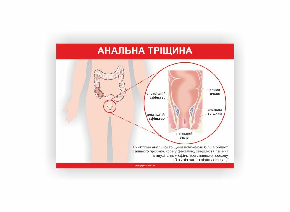 Плакат Vivay Анальная трещина 60х40 см (25636177)
