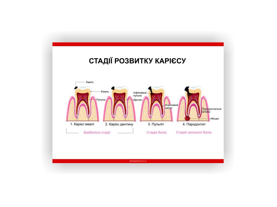 Плакат Vivay Стадии развития кариеса 118х84 см (25738363)