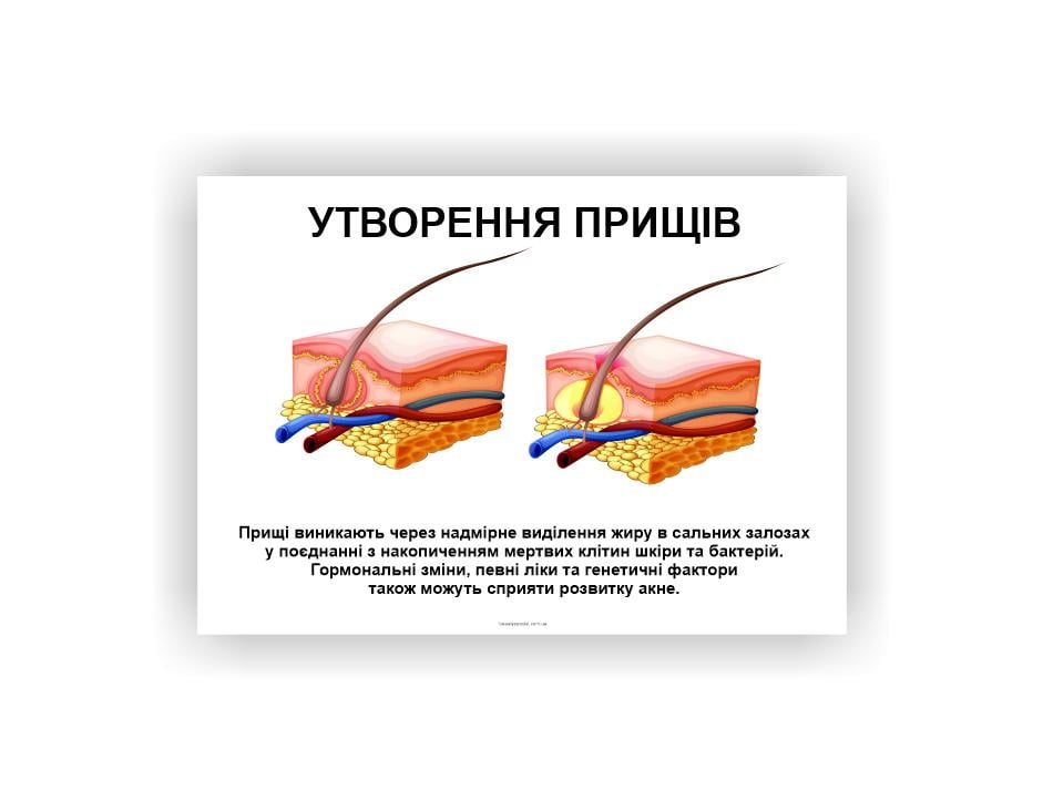 Плакат Vivay Образование прыщей 30х40 см (25635341)