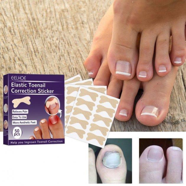 Набор пластырей Elastic Toenail Correction Sticker для безболезненной коррекции вросших ногтей 50 шт. (9388-3) - фото 5