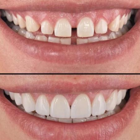 Вініри зубні Perfect Smile Veneers змінні White (kz059) - фото 4