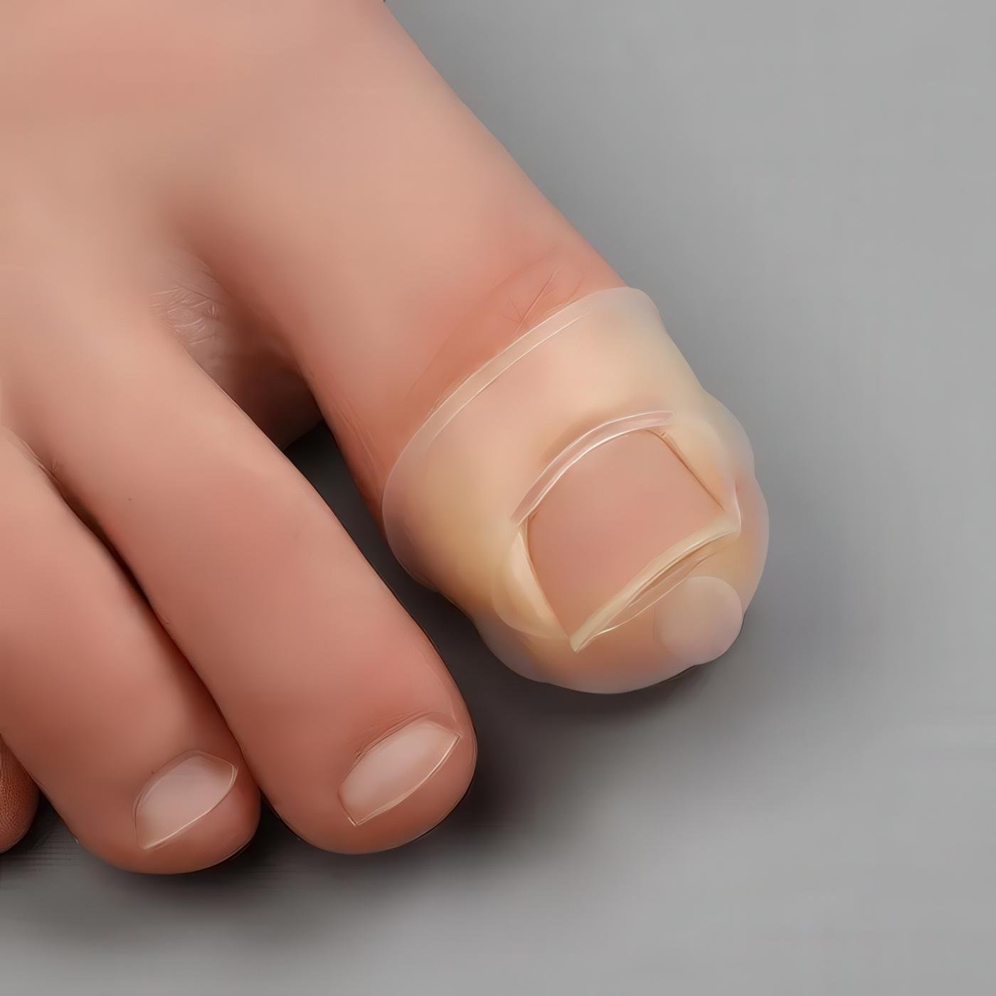 Накладки силіконові для корекції врослих нігтів 1 пара - фото 8 Накладки силіконові для корекції врослих нігтів 1 пара - фото 8