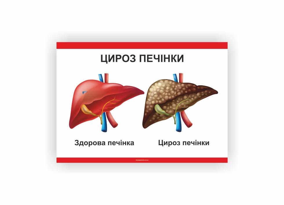 Плакат Vivay Цироз печени 30х40 см (25825644)