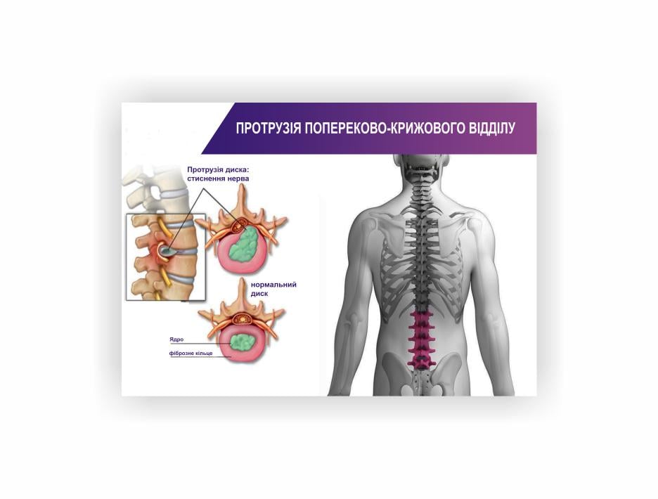 Плакат Vivay "Протрузия пояснично-крестцового отдела" 60х40 см (25807570)