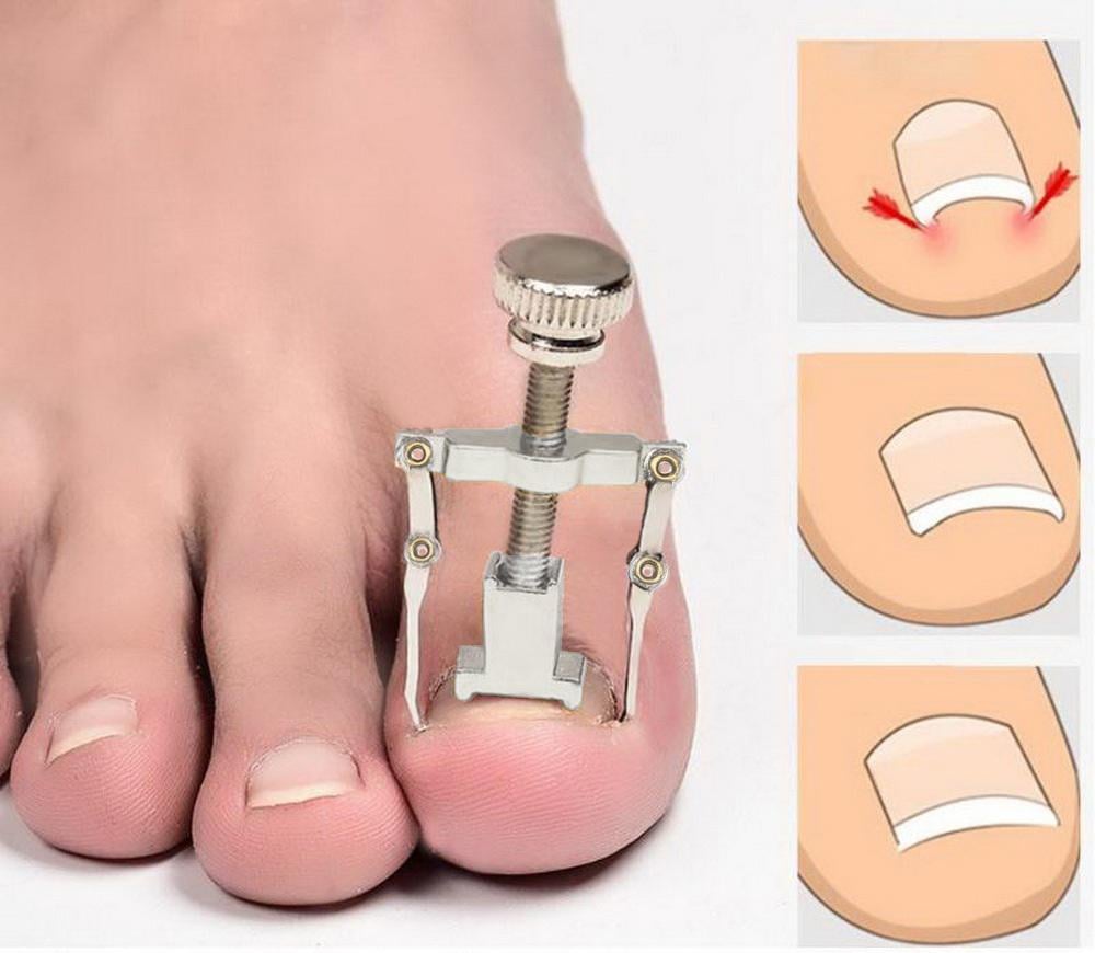 Коректор з металу для лікування врослого нігтя (R9480) - фото 8