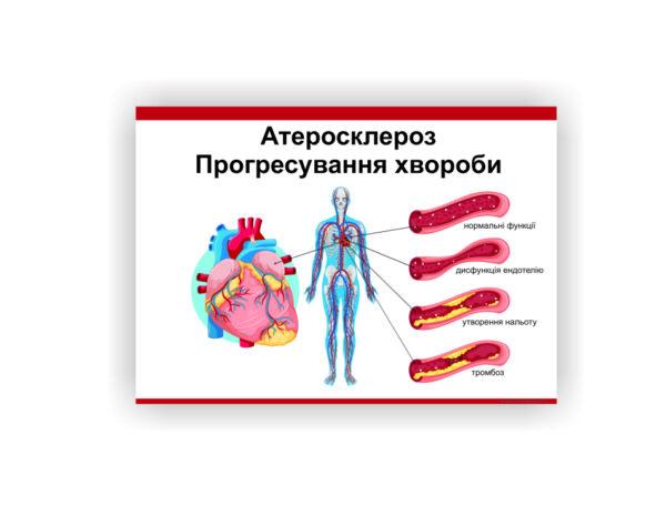 Плакат Vivay "Атеросклероз" 118х84 см (25764108)