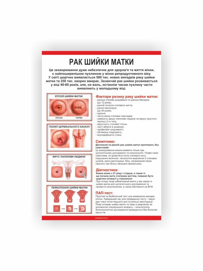 Плакат Vivay Рак шийки матки 60x40 см (26866329)