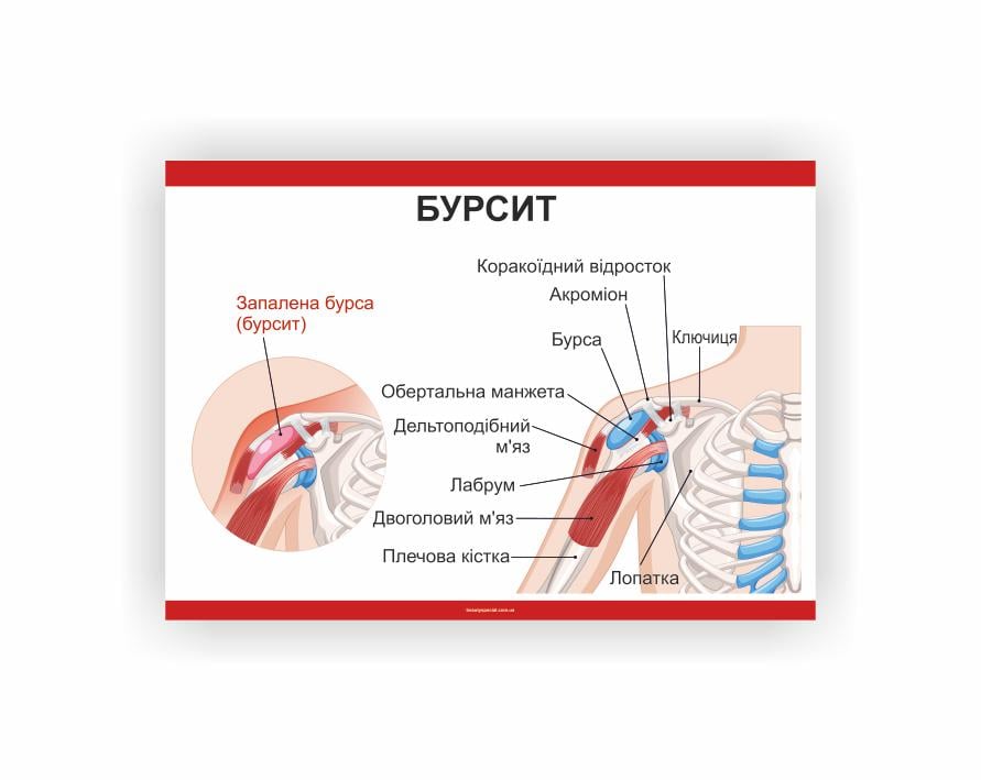 Плакат Vivay Бурсит 30х40 см (25832890)