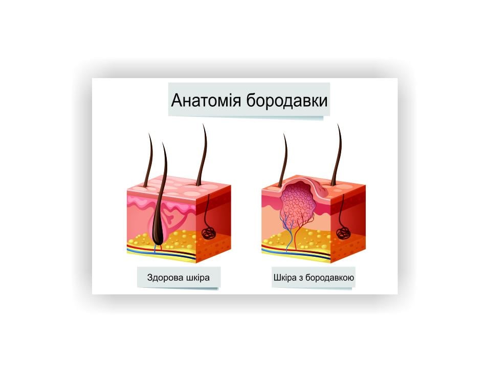 Плакат Vivay Анатомия бородавки 60х40 см (25604208)