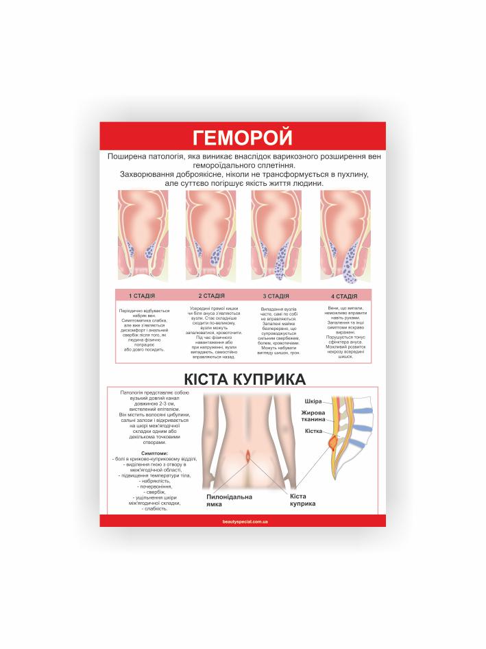 Плакат Vivay Геморой 60х40 см (25636167)