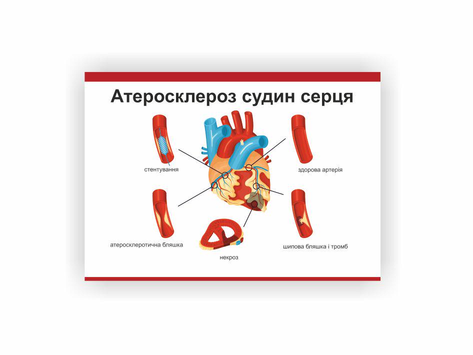 Плакат Vivay "Атеросклероз сосудов сердца" 60х80 см (25807505)