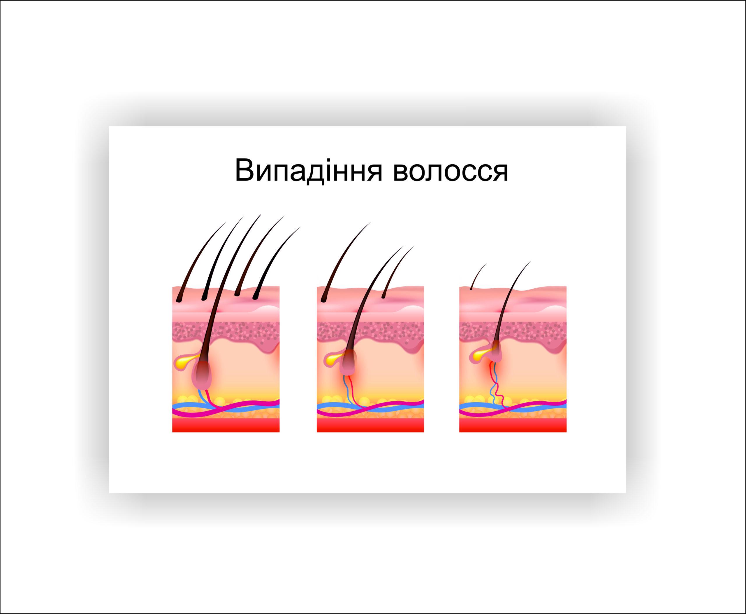 Плакат Vivay Выпадение волос 30х40 см (25631568)