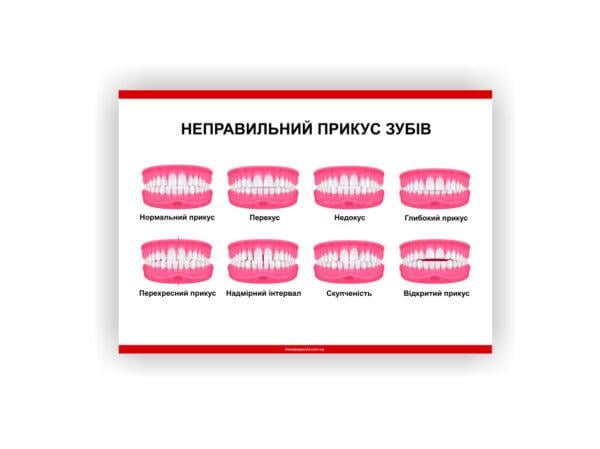 Плакат Vivay Неправильный прикус зубов 30х40 см (25738295)