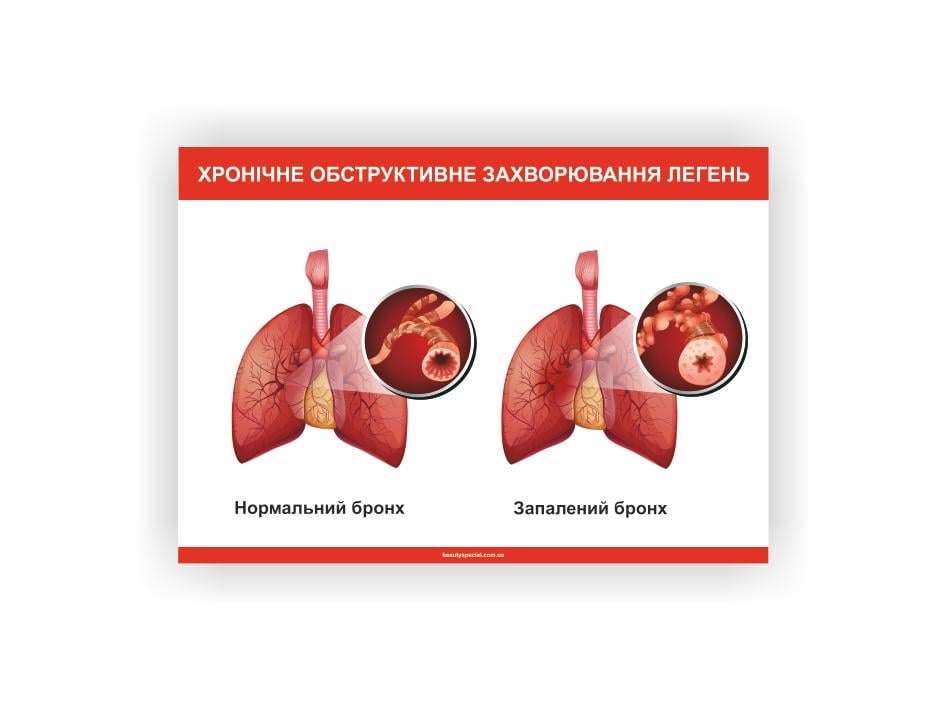 Плакат Vivay Хроническая обструктивная болезнь легких 30x40 см (26992778)