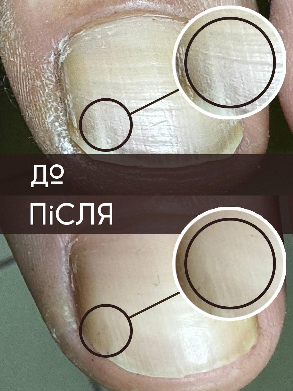 Крем фунгицидный противогрибковый крем 30 мл - фото 2 Крем фунгицидный противогрибковый крем 30 мл - фото 2