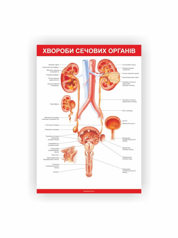 Плакат Vivay Болезни мочевых органов 30х40 см (25636120)