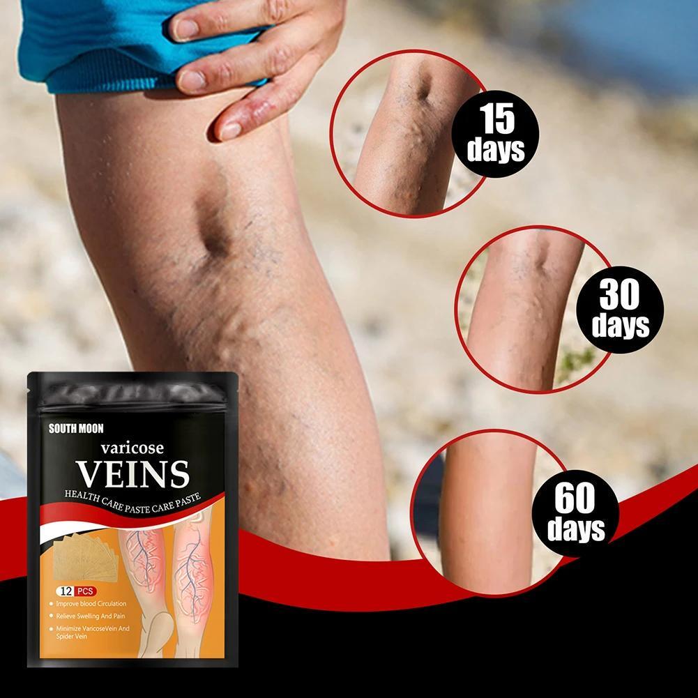 Медичний пластир Varicose Veins Health Care Paste для лікування варикозного розширення вен 10 шт. Бежевий (2149939271) - фото 5