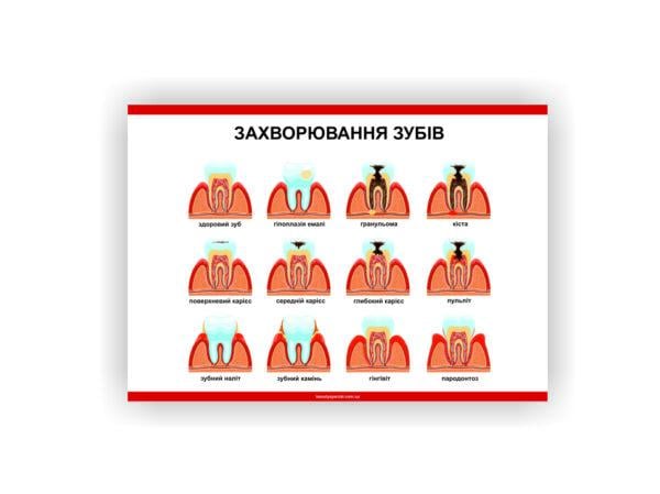 Плакат Vivay Заболевания зубов 30х40 см (25738476)