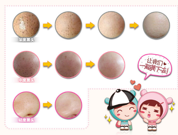 Маска для лица трехступенчатая система очистки пор BioAqua Remove Black Heads 3-step Kit от черных точек (0104011) - фото 5 Маска для лица трехступенчатая система очистки пор BioAqua Remove Black Heads 3-step Kit от черных точек (0104011) - фото 5