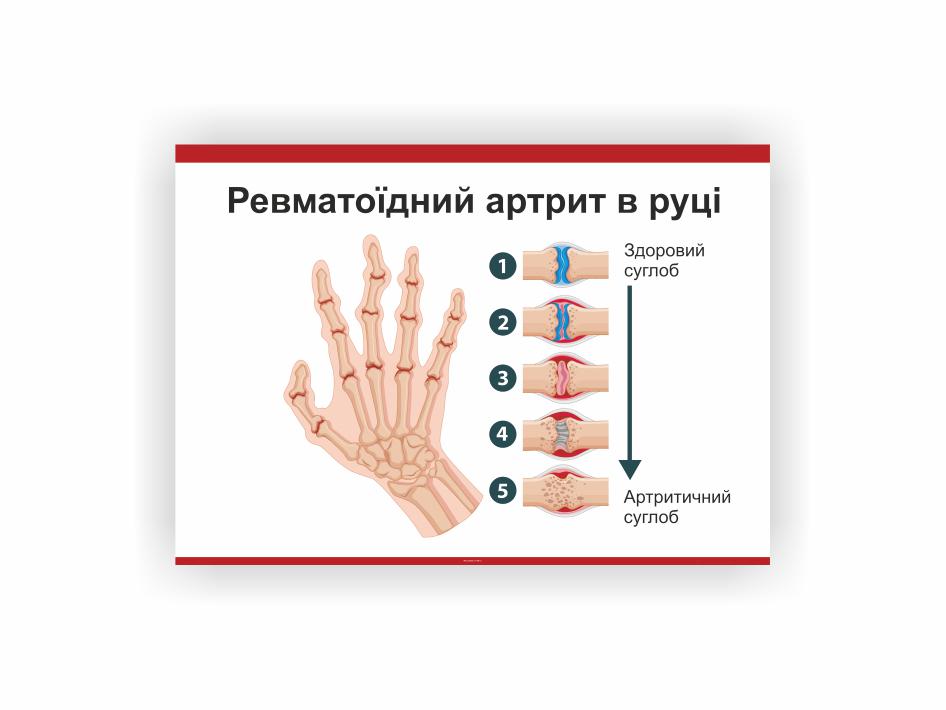 Плакат Vivay Ревматоидный артрит в руке 60х40 см (25671364)