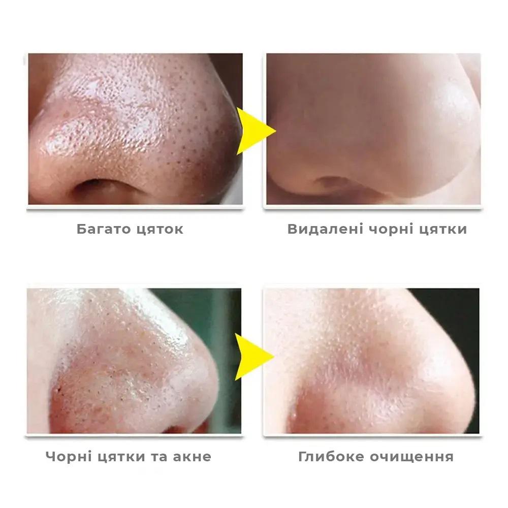 Маска для обличчя Lanbena від вугрів і чорних крапок 30 г з 60 смужками 30 г (27259378) - фото 2 Маска для обличчя Lanbena від вугрів і чорних крапок 30 г з 60 смужками 30 г (27259378) - фото 2