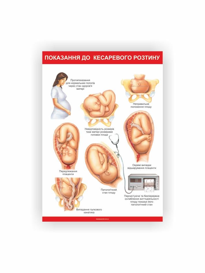 Плакат Vivay Показания к кесареву сечению 30х40 см (25636095)