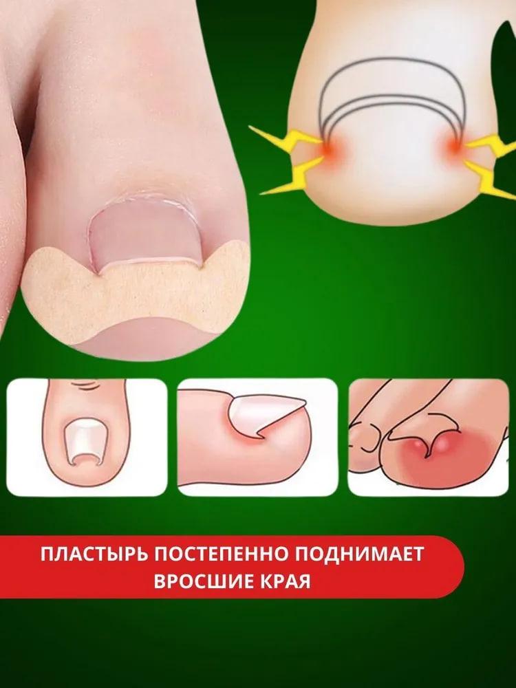 Пластыри Elastic Toenail Correction Sticker для коррекции и устранения вросших ногтей 50 шт. (429554558) - фото 3