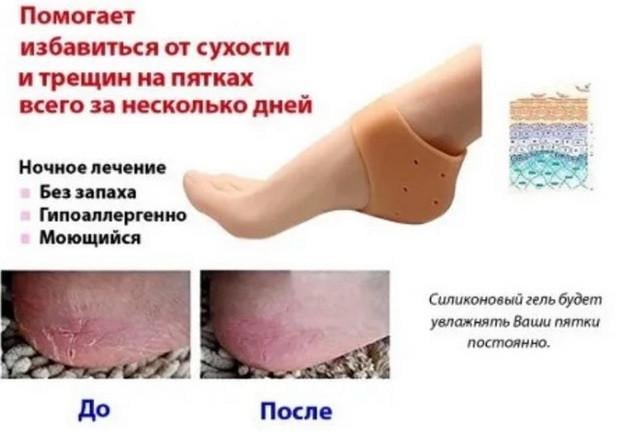 Фіксатор силіконовий для п'ят Heel anti-crack sets (21565296) - фото 3