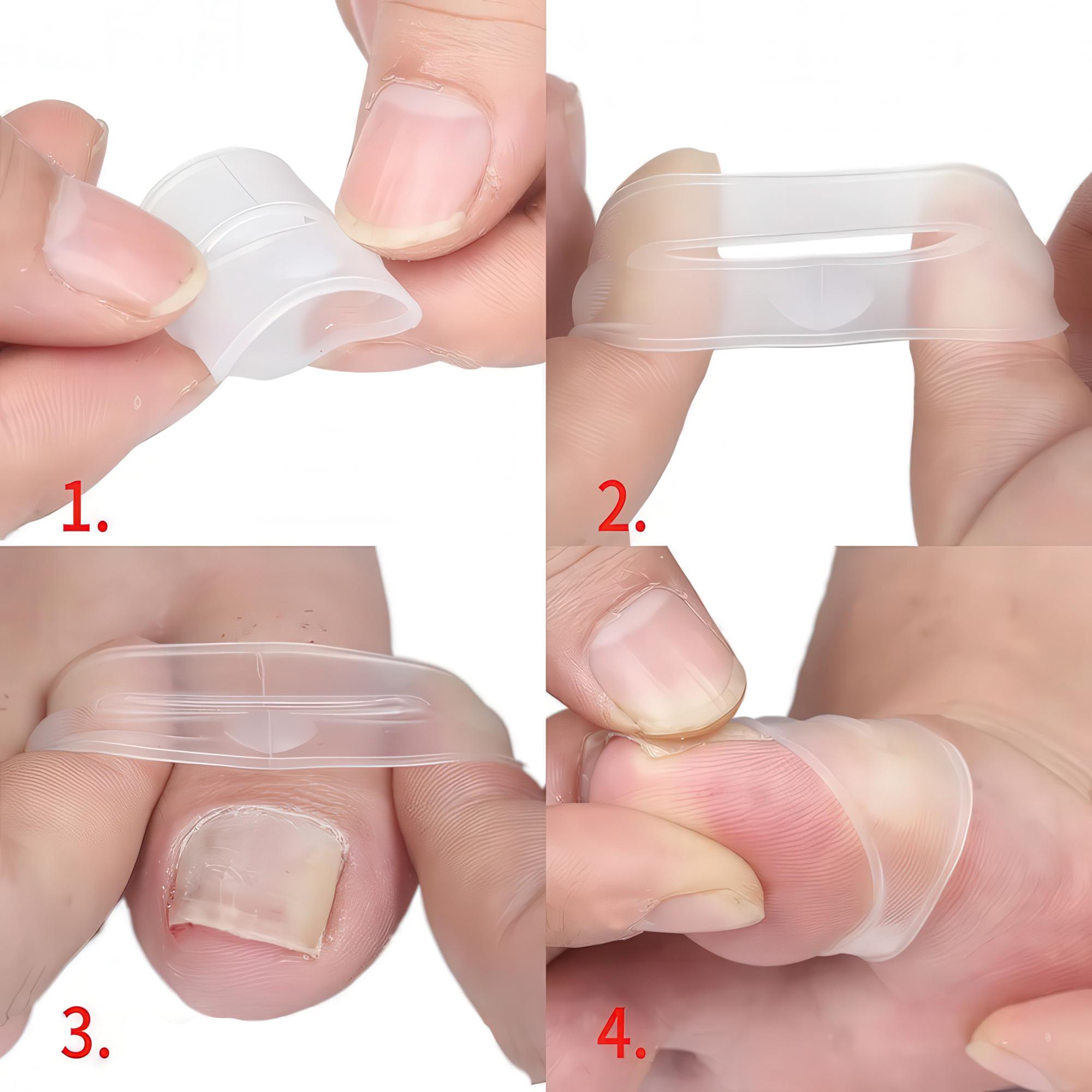Накладки силіконові для корекції врослих нігтів 1 пара - фото 6 Накладки силіконові для корекції врослих нігтів 1 пара - фото 6