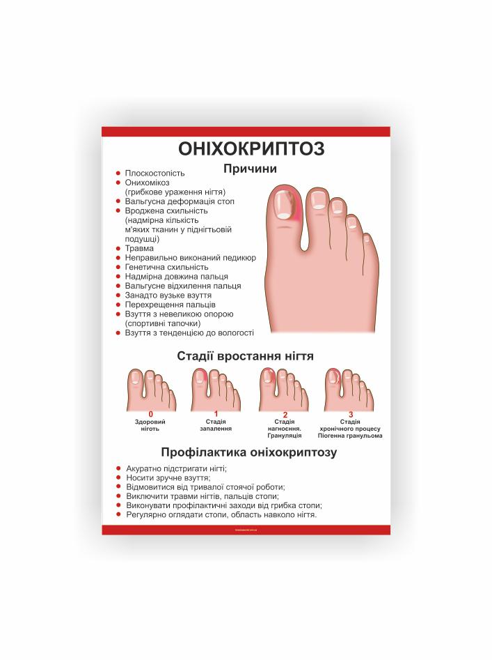 Плакат Vivay Оніхокриптоз 60х40 см (25698442)