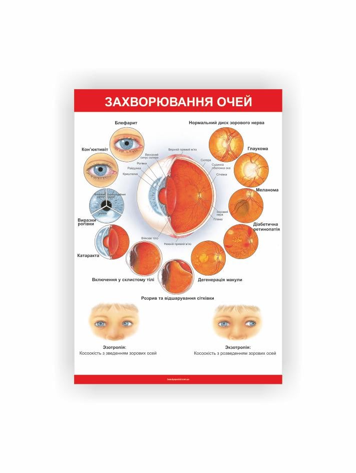 Плакат Vivay Заболевания глаз 60х40 см (25705896)
