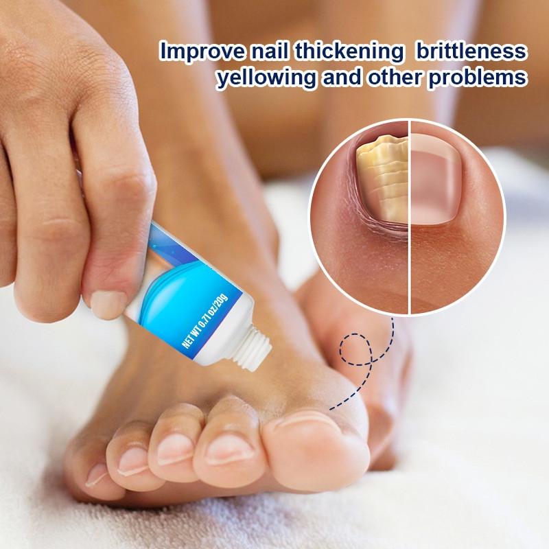 Крем противогрибковый для ног Nail Fungus Treatment Cream Sumifun 20 г - фото 4 Крем противогрибковый для ног Nail Fungus Treatment Cream Sumifun 20 г - фото 4