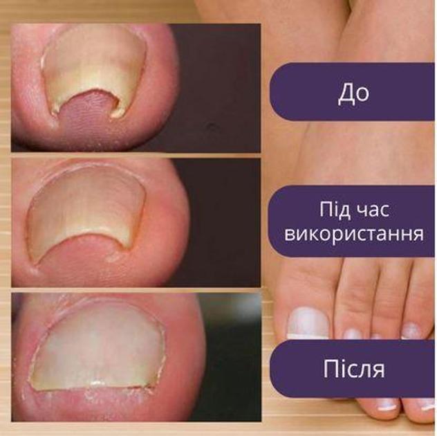 Набор пластырей Elastic Toenail Correction Sticker 50 pcs (ECS1000) - фото 4