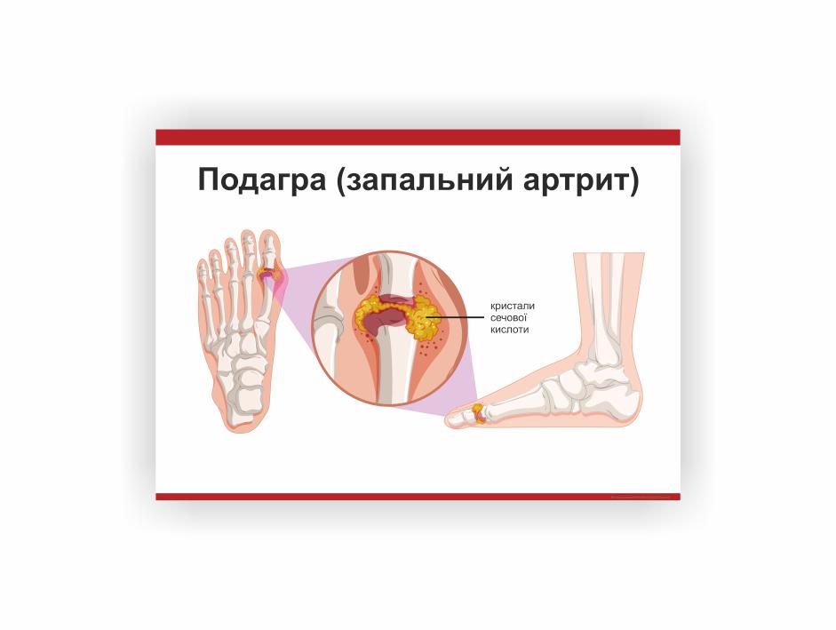 Плакат Vivay Подагра 60х40 см (25826465)