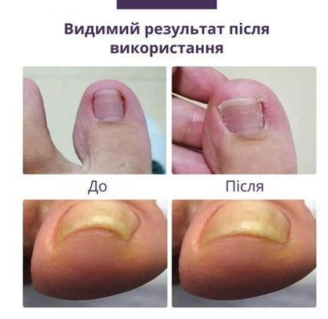 Набор пластырей Elastic Toenail Correction Sticker 50 pcs (ECS1000) - фото 5