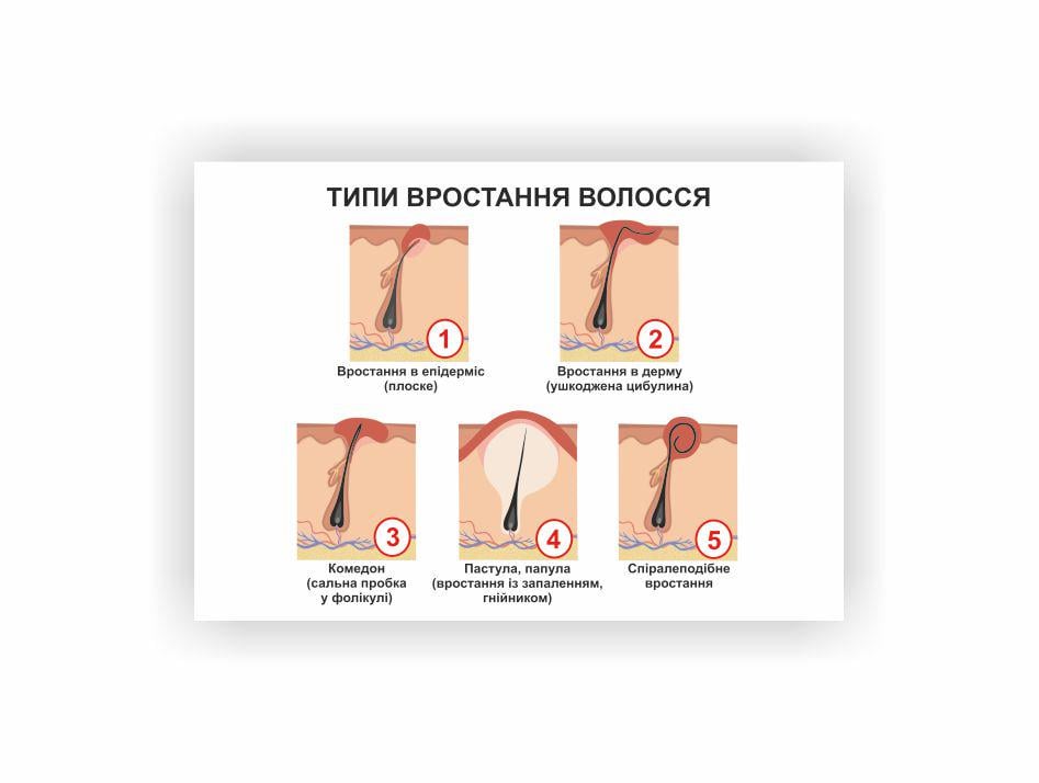 Плакат Vivay Типы врастания волос 30х40 см (25602619)