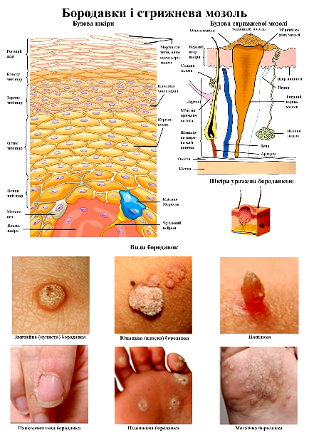 Анатомічний плакат Бородавки та стрижнева мозоль 420x594 мм (0027)