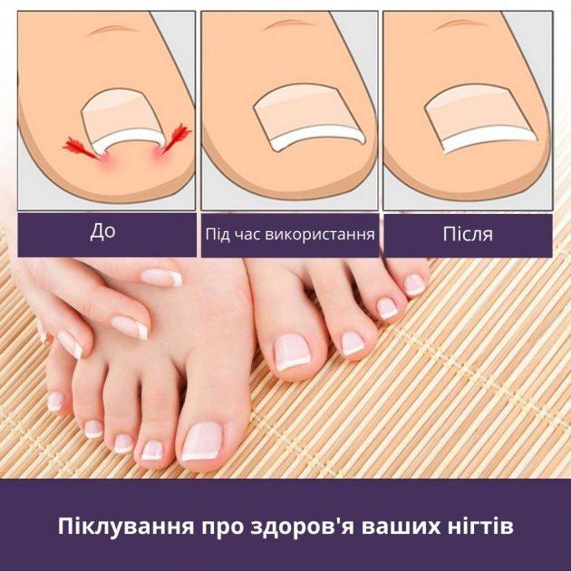 Набор пластырей Elastic Toenail Correction Sticker для безболезненной коррекции вросших ногтей 50 шт. (9388-3) - фото 2