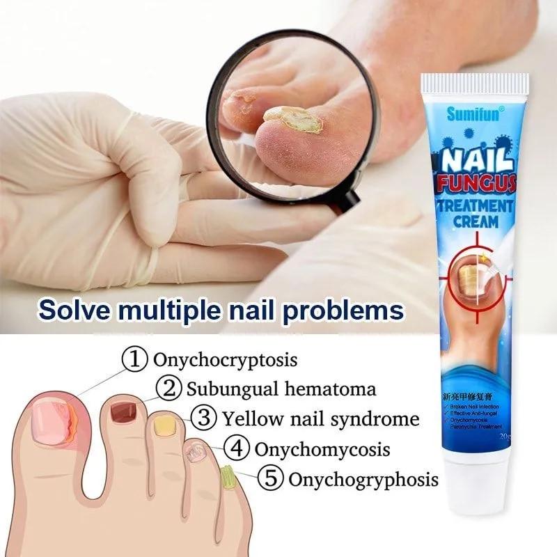Крем противогрибковый для ног Nail Fungus Treatment Cream Sumifun 20 г - фото 2 Крем противогрибковый для ног Nail Fungus Treatment Cream Sumifun 20 г - фото 2