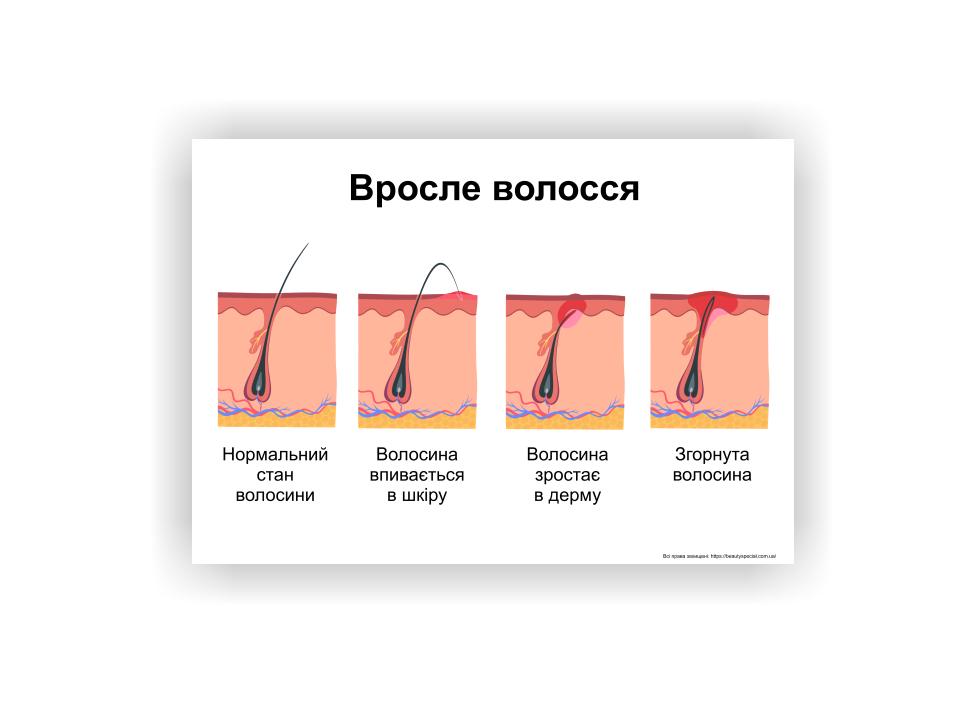 Плакат Vivay Вросший волос 30х40 см (25604150)