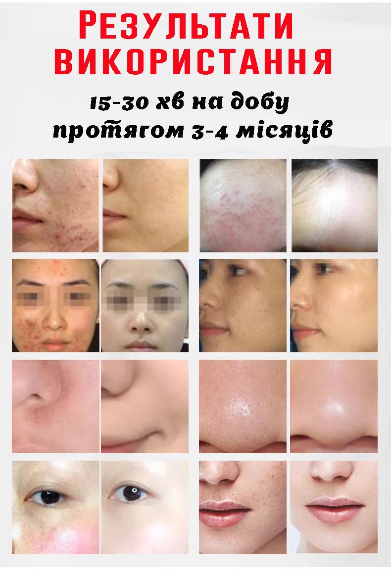 Лампа-дуга для фотодинамической терапии LED-2025 (30068274) - фото 8