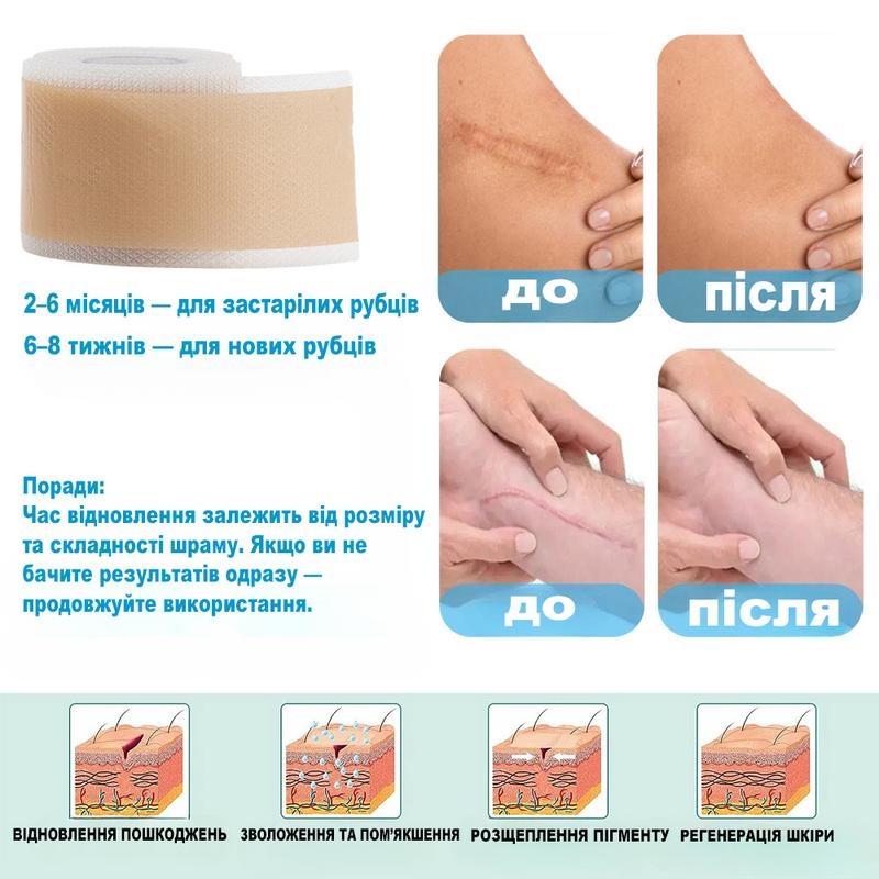 Пластырь для заживления рубцов после операции медицинский силиконовый при ожогах/растяжка/акне - фото 8
