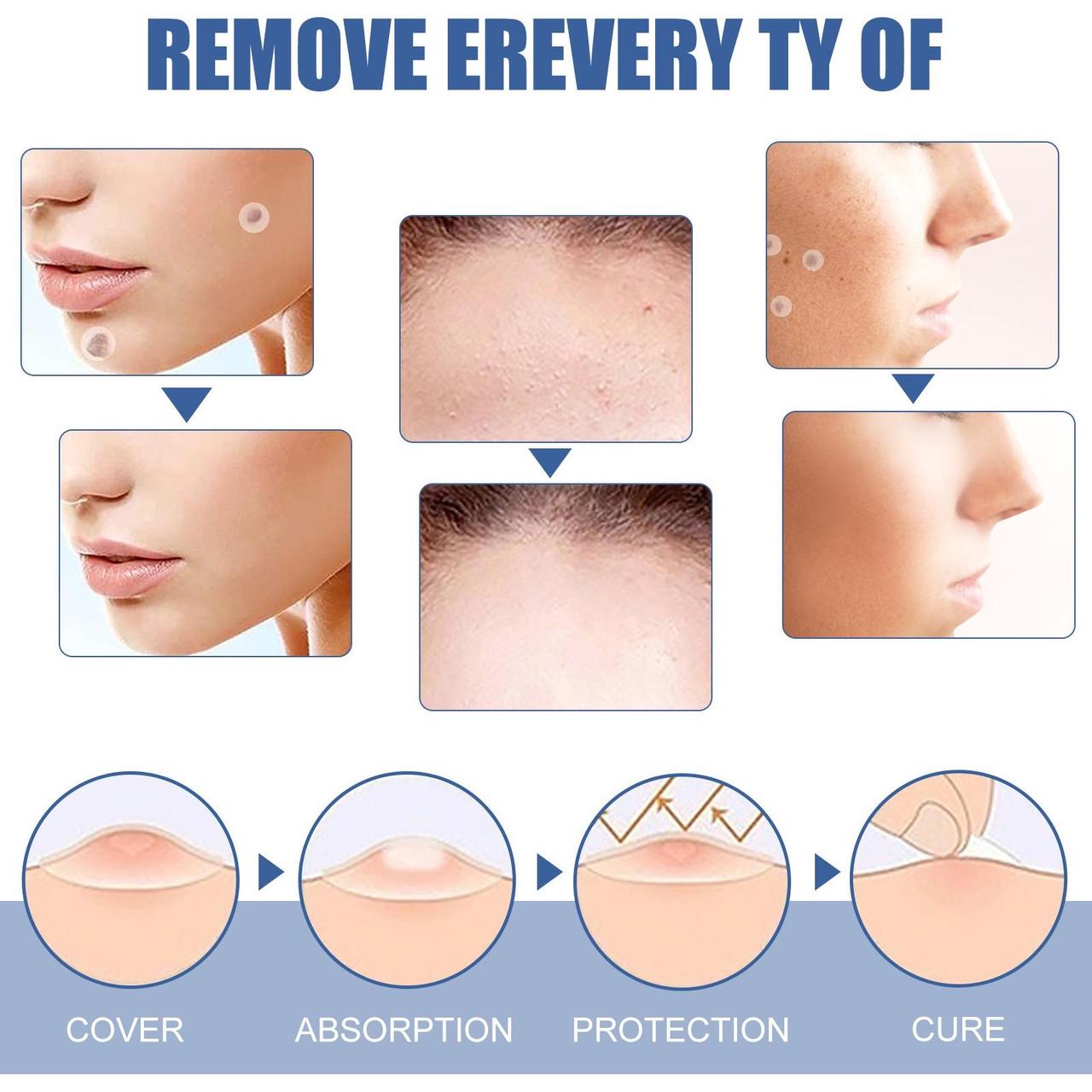 Пластырь от папиллом/бородавок/родинок/угревой сыпи 36 шт. - фото 3 Пластырь от папиллом/бородавок/родинок/угревой сыпи 36 шт. - фото 3