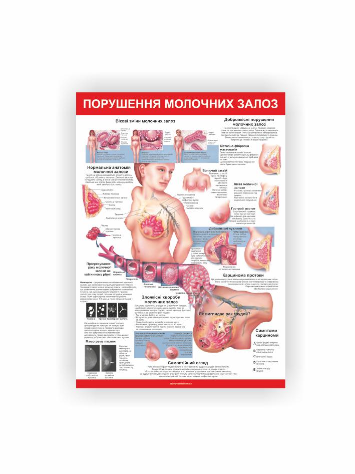 Плакат Vivay Нарушение молочных желез 30x40 см (26943988)